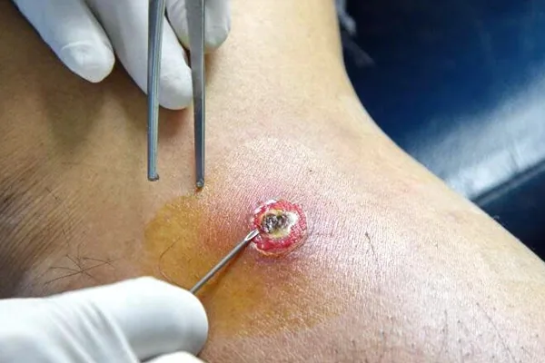 Treating Serious Bacterial Infections in Drug Users