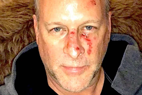 Comedian Dave Coulier Shares Bloodied Photo